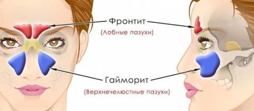 Как проявляются гайморит и фронтит? от каких слов происходят название этих болезней?