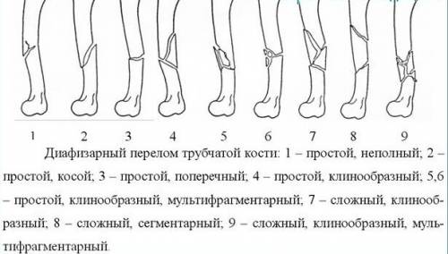 Какте бывают виды переломов (6 видов)