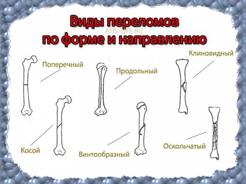 Какте бывают виды переломов (6 видов)