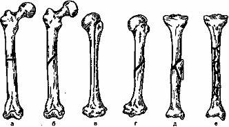 Какте бывают виды переломов (6 видов)