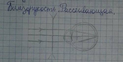 1. Какой недостаток зрения показан на рисунке? Нарисуйте необходимую линзу для исправления недостатк