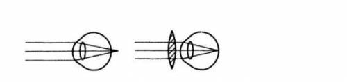 Какой недостаток зрения показан на рисунке? Какую необходимую линзу в очках используют для исправлен
