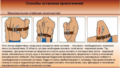 Опишите временной остановки кровотечения: Максимальное сгибание конечности в суставе;